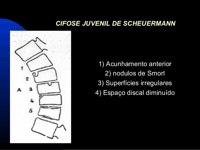 cifose juvenil de scheuermann